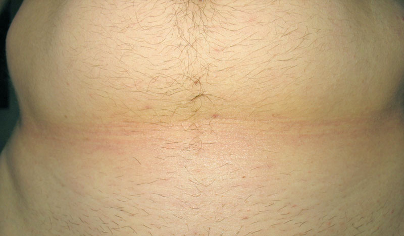 épilation ventre femme épilation ventre femme